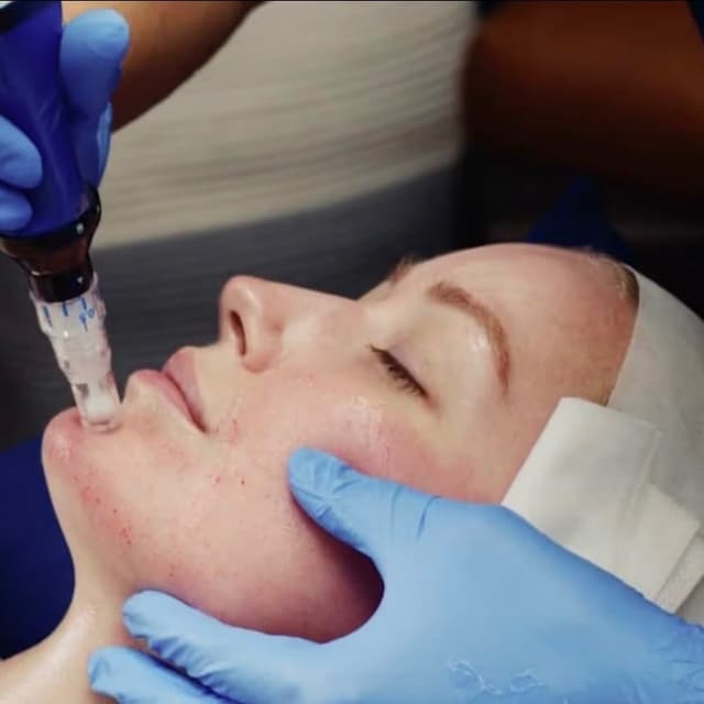 Special 3 Microneedlings at Vanessa’s Skin Studio in Wilmington, NC